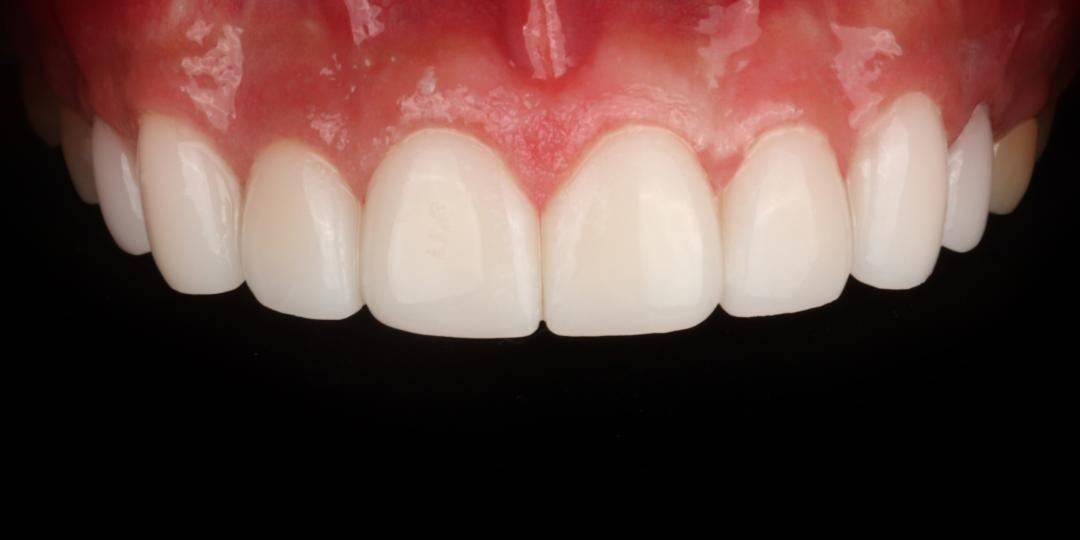 ラミネート 症例3 施術後